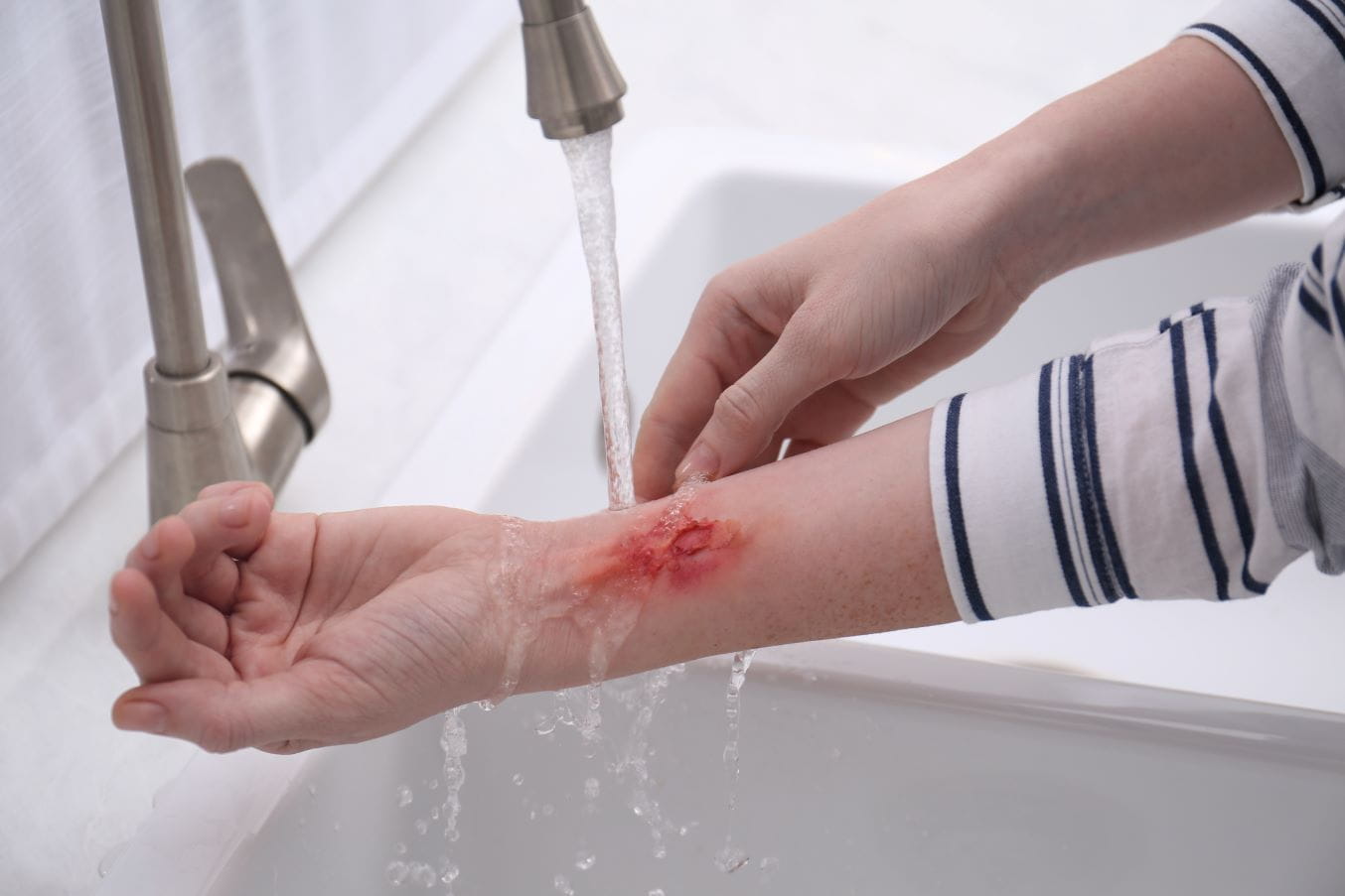 Someone is running water over a burn on their arm over the sink.